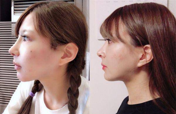 小偶像花700万日元整成这样，值吗？