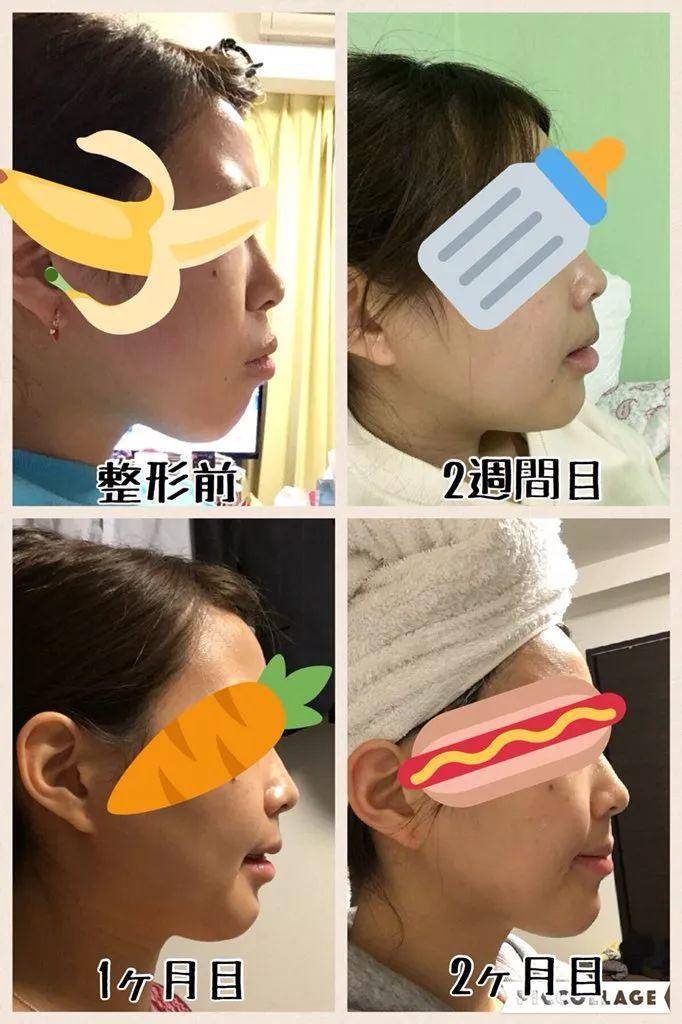 小偶像花700万日元整成这样，值吗？